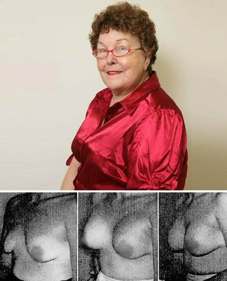 Timmie Jean Lindsey, the First Woman to Have Breast Implants: In 1962, a young Texan housewife named Timmie Jean Lindsey was persuaded to become a guinea pig for a new operation. As the first woman to receive silicone breast implants, she has paved the way for more than two million women who have undergone surgical enhancements.