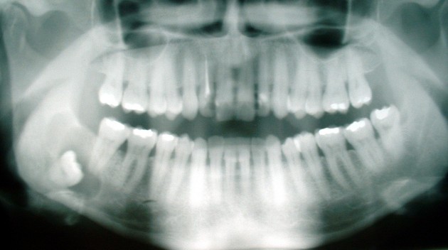 Wisdom Teeth: These are teeth that we surely don’t need