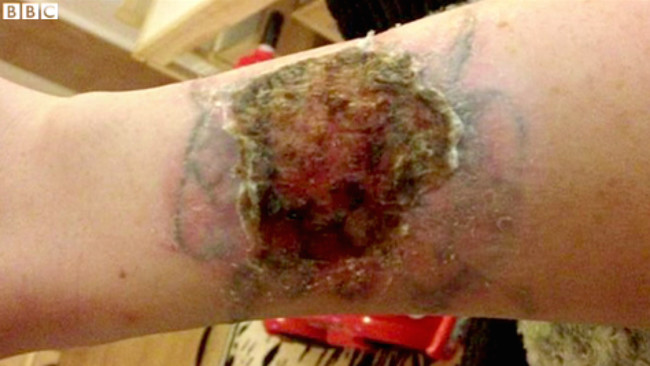 The chemical in the kit, TCA, is extremely corrosive. It burned away her skin and left a hole in her arm.