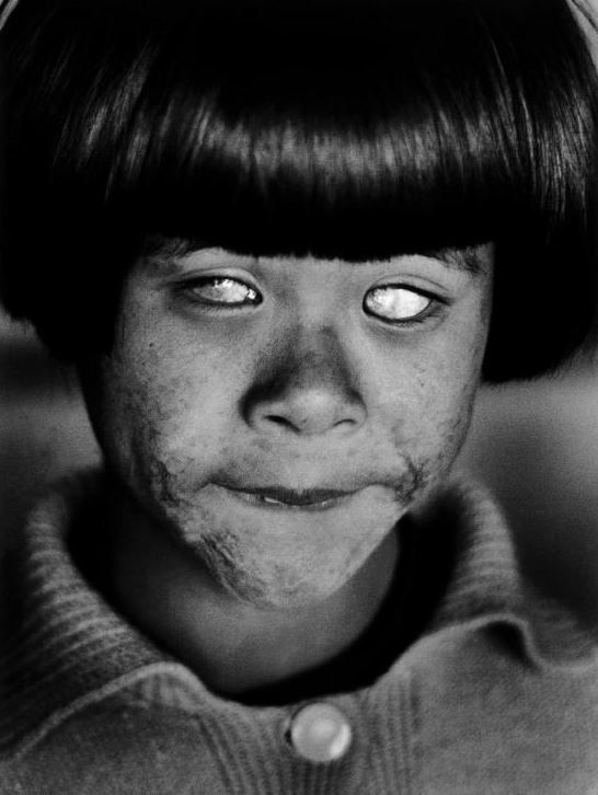 This girls eyes clouded over after witnessing the nuclear blast at Hiroshima.