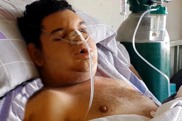 Orlando Andrés Jiménez from Peru is fighting for his life in hospital after he was bitten on the neck by what is believed to be a Chilean recluse spider.