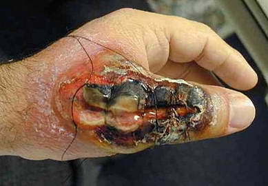 A species of arachnid known to be one of the deadliest in the world – it contains venom which causes necrosis of the skin. Chilean Recluse bites are exceedingly rare, but when they occur the results are truly horrific, as this guy’s hand demonstrates.