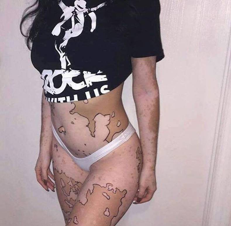 random pic vitiligo model map