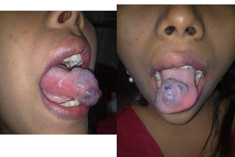 hemangioma tongue