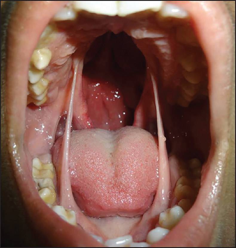 oral synechiae