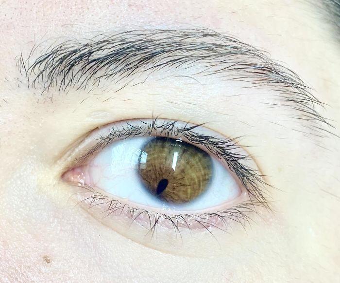 distichiasis single vs double row of eyelashes - m