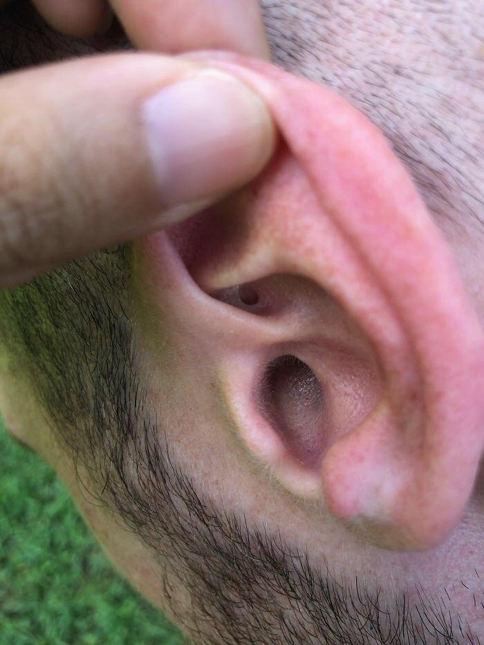 hole in my ear