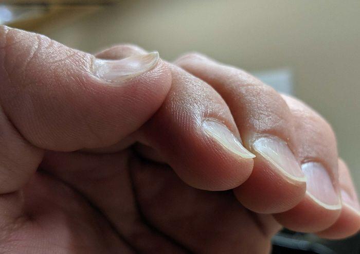 inverted fingernails