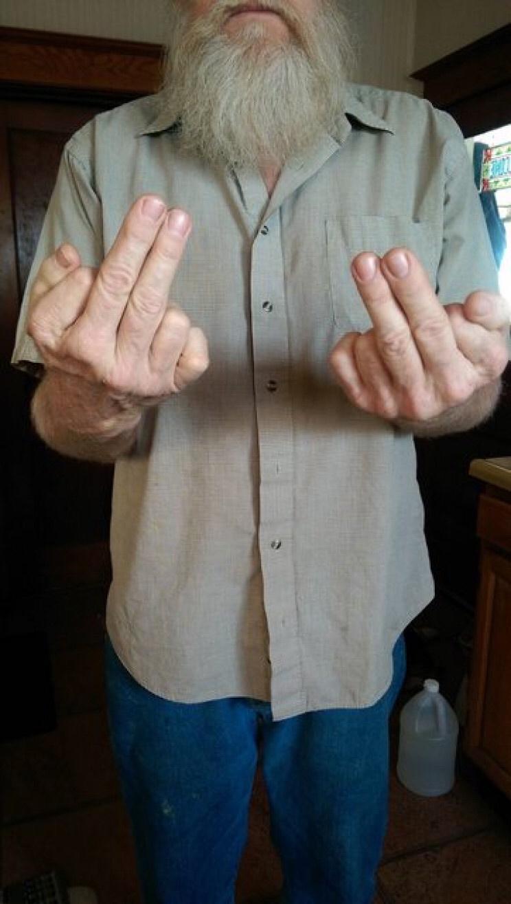 man with six fingers