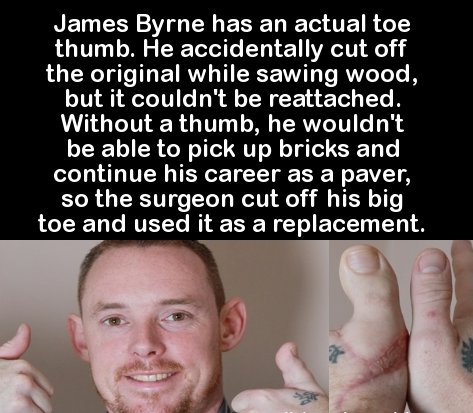photo caption - James Byrne has an actual toe thumb. He accidentally cut off the original while sawing wood, but it couldn't be reattached. Without a thumb, he wouldn't be able to pick up bricks and continue his career as a paver, so the surgeon cut off h
