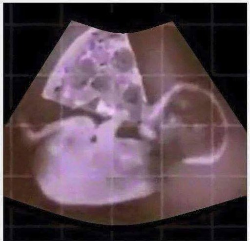 My friend's baby was two weeks late, this was her last pic in the womb...