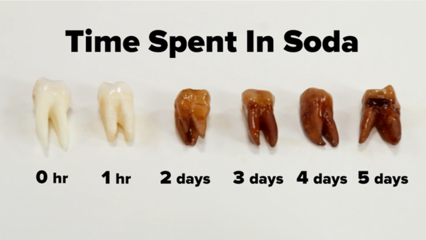 soda bad for teeth - Time Spent In Soda O hr 1 hr 2 days 3 days 4 days 5 days