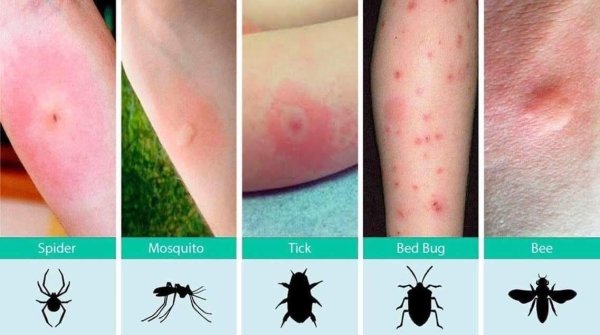 infographics - charts - bed bug bites vs mosquito bites - Spider Mosquito Tick Bed Bug Bee