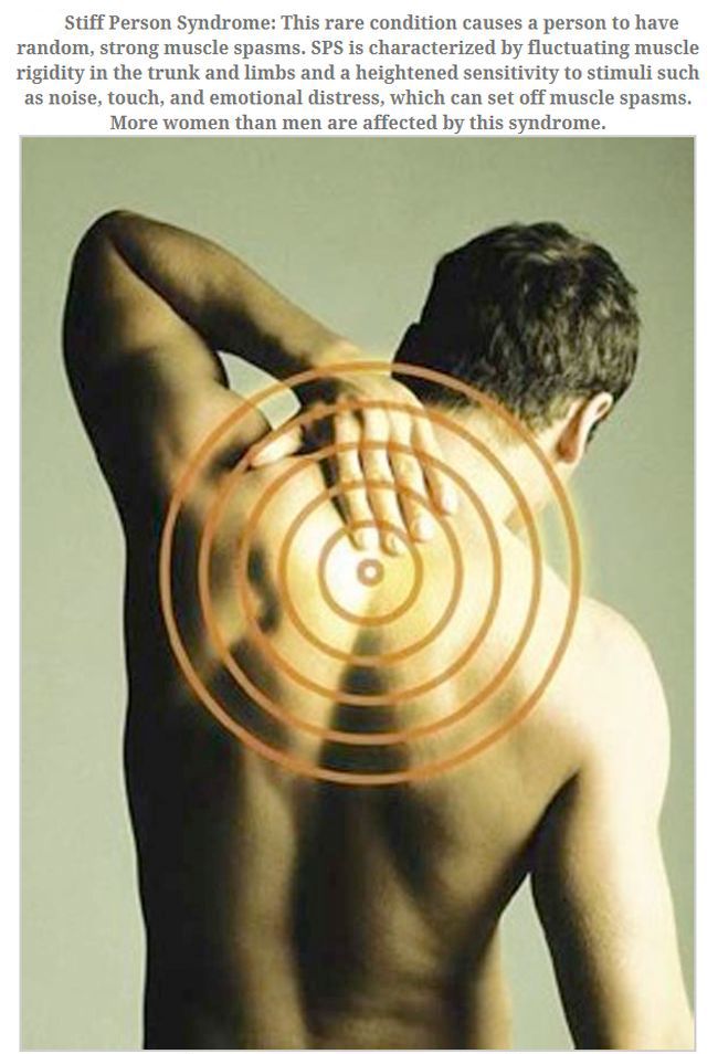 upper back pain - Stiff Person Syndrome This rare condition causes a person to have random, strong muscle spasms. Sps is characterized by fluctuating muscle rigidity in the trunk and limbs and a heightened sensitivity to stimuli such as noise, touch, and 
