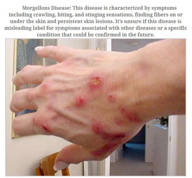 morgellons disease - Morgellons Disease This disease is characterized by symptoms including crawling, biting, and stinging sensations, finding fibers on or under the skin and persistent skin lesions. It's unsure if this disease is misleading label for sym