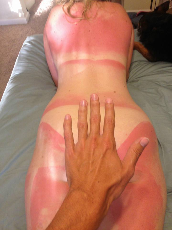 Girlfriend's major sunburn