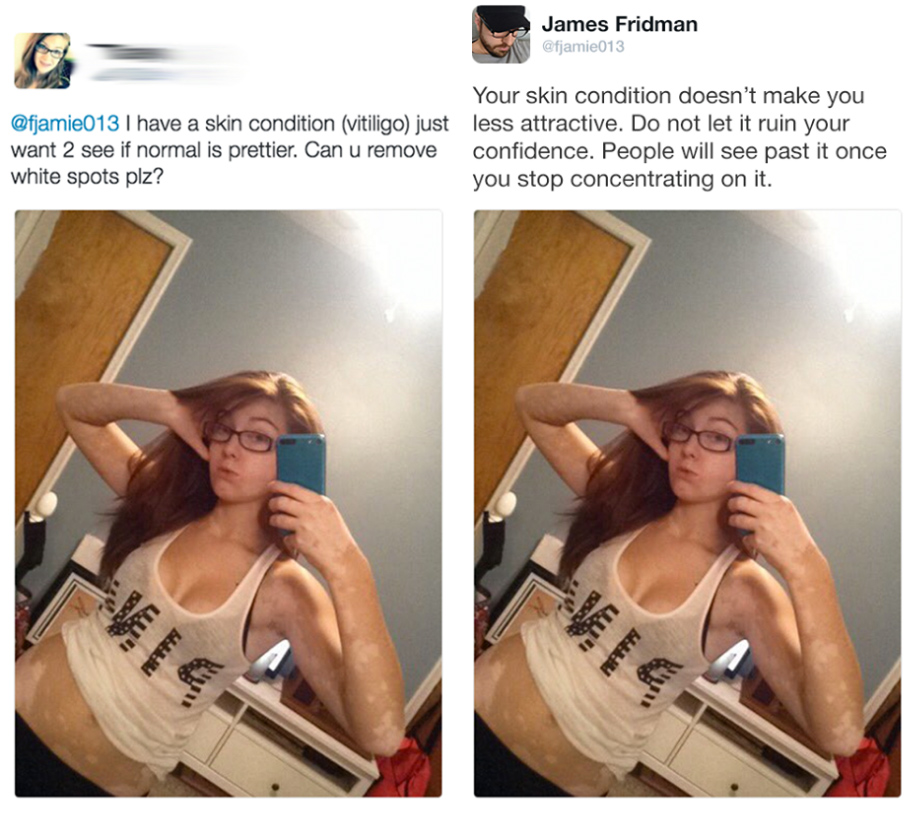 james fridman vitiligo - James Fridman Your skin condition doesn't make you I have a skin condition vitiligo just less attractive. Do not let it ruin your want 2 see if normal is prettier. Can u remove confidence. People will see past it once white spots 