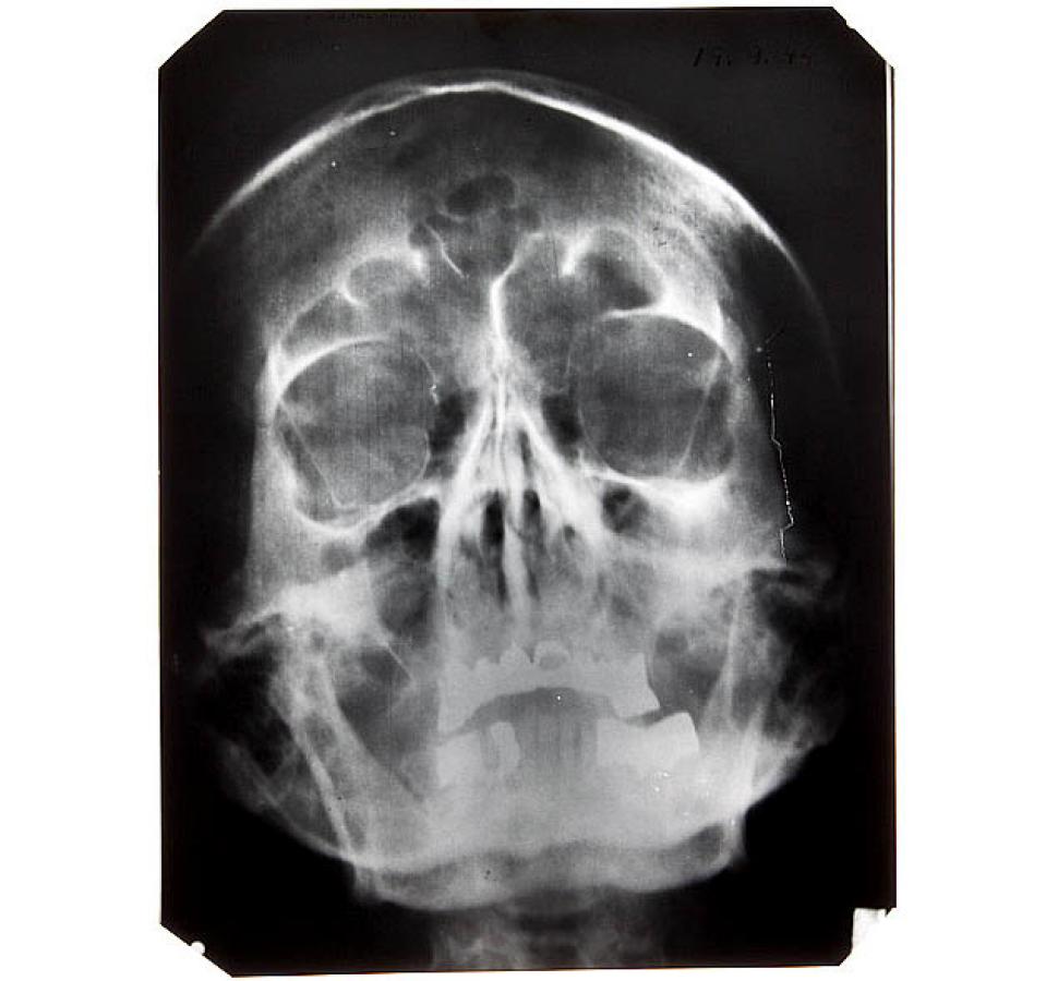 (A nice X-Ray of supposedly Adolf Hitler's skull) Hitler dosed himself up with cocktails of drugs in an attempt to become superhuman with "Vision enhancing cocaine eyedrops" and "Muscle stimulating opium" and various other drugs, these had a totally opposite effect and left Hitler in his personal bunker with arms shaking so much he found it impossible to write, his glasses had to be modified, commanding imaginary armies in Berlin and a nervous delusional wreck.