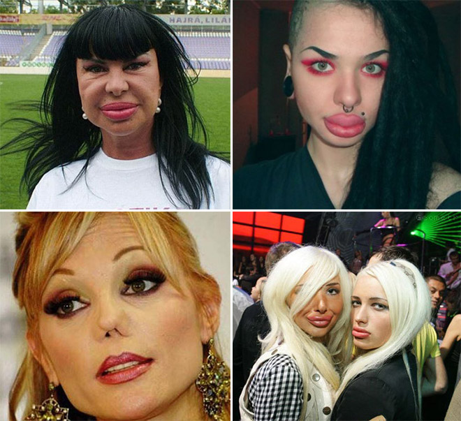 15 Times Plastic Surgery Went Horribly Wrong
