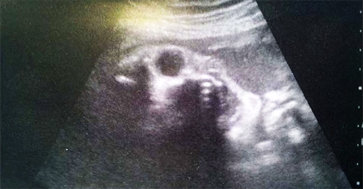 Usually when pregnant moms go to get an ultrasound, its a joyous occasion, where they get to see the baby growing inside them. Just think how this mother felt when she saw the ultrasound of her “baby.” We don’t know what week this was taken in, but we assume the mom was as creeped out as we were when we saw this scary image.