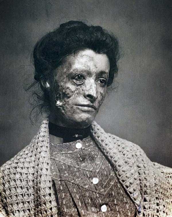 Victorian era postmortem photograph of a burn victim.