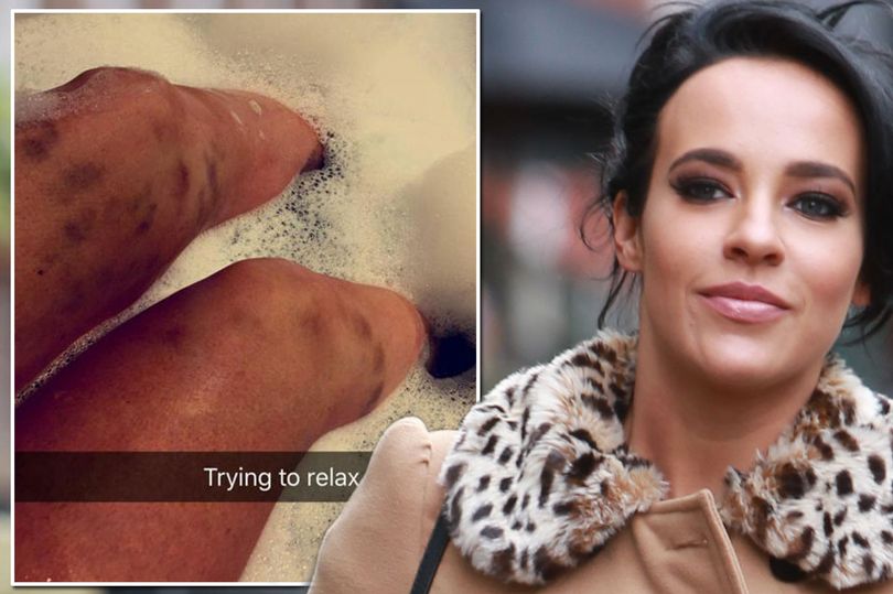 Is Stephanie Davis covered in bruises?