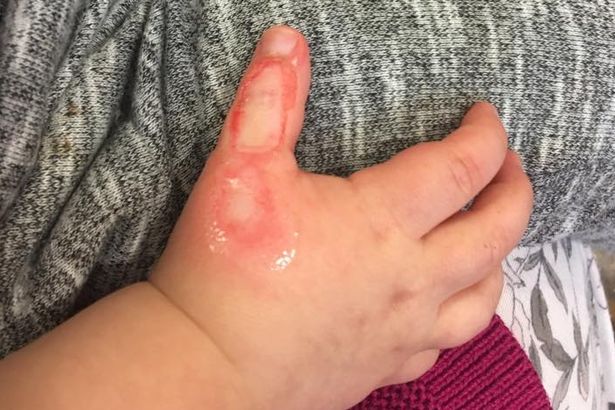 Young mum reveals dangers of hoovering with toddler after 16-month-old son suffers potentially 'life-changing injuries' includin