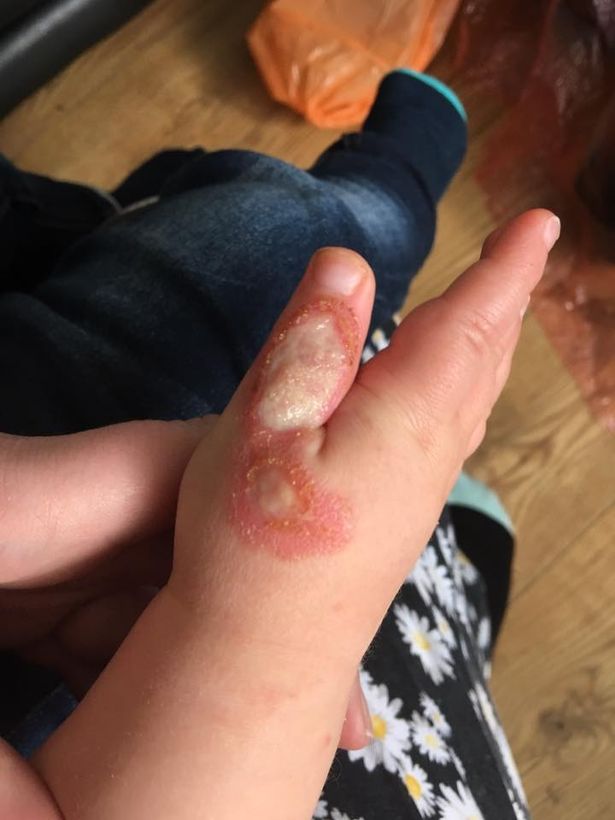 Young mum reveals dangers of hoovering with toddler after 16-month-old son suffers potentially 'life-changing injuries' includin