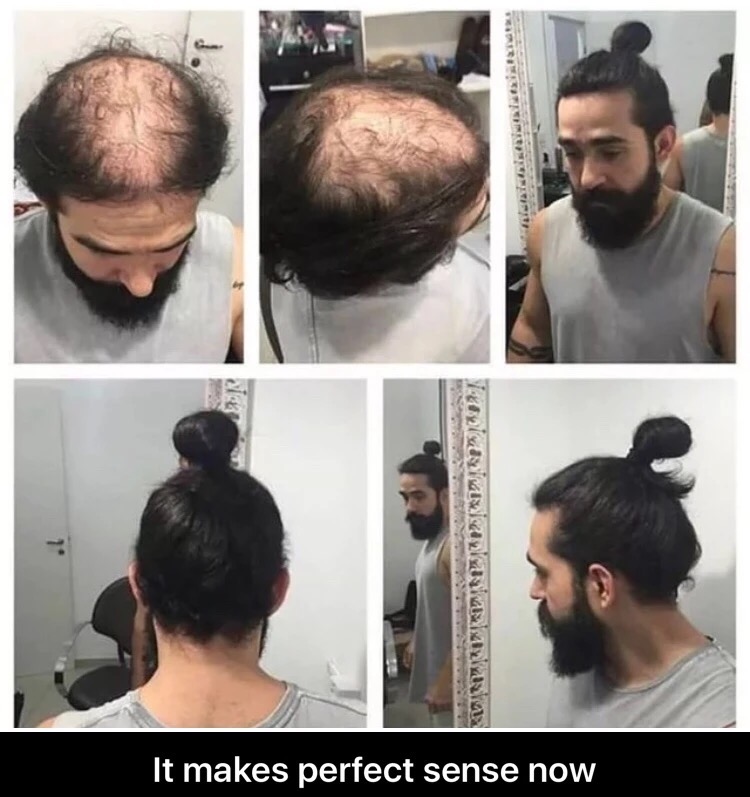 man bun bald spot - It makes perfect sense now