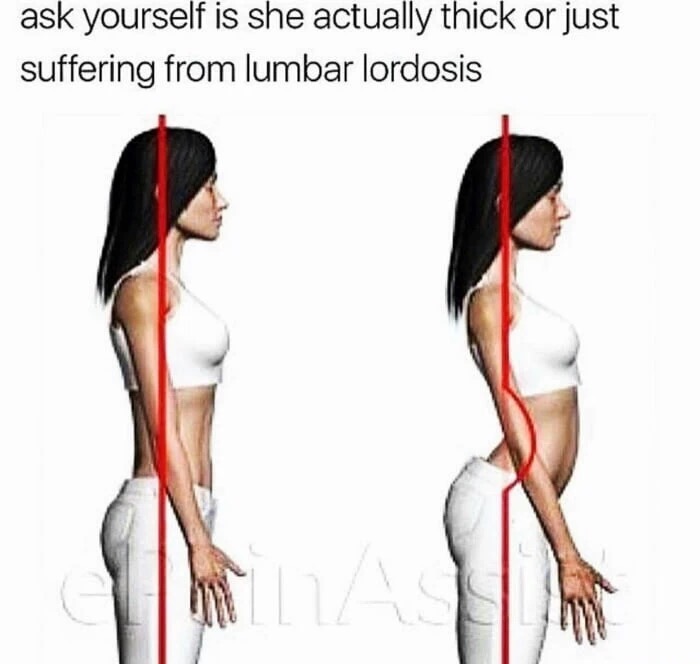 lumbar lordosis thicc - ask yourself is she actually thick or just suffering from lumbar lordosis