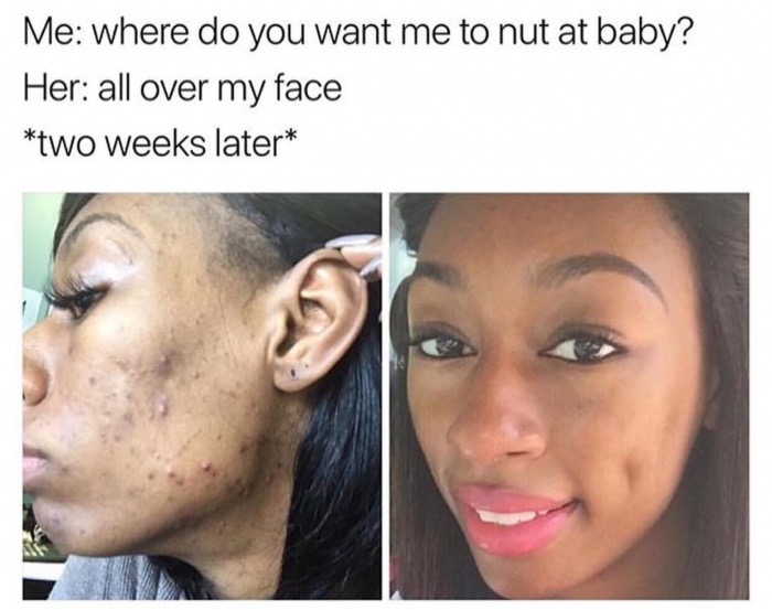 sperms for pimples - Me where do you want me to nut at baby? Her all over my face two weeks later