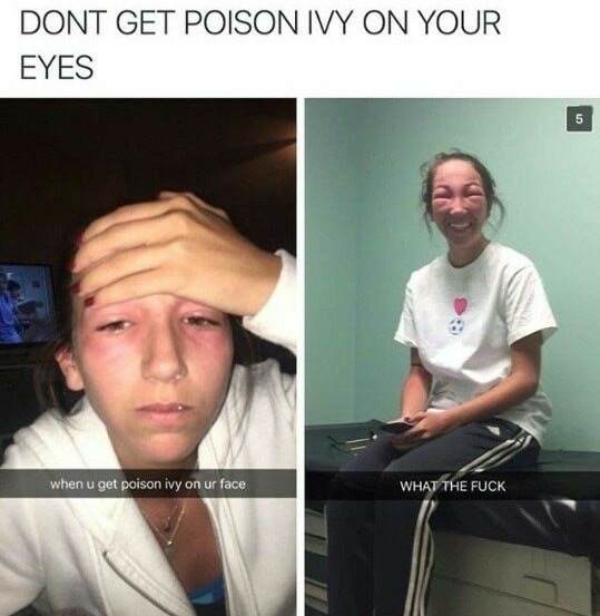 girl who got poison ivy on her eyes - Dont Get Poison Ivy On Your Eyes when u get poison ivy on ur face What The Fuck
