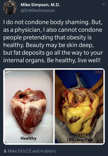 memes - visceral fat - Mike Simpson, M.D. Simpson I do not condone body shaming. But, as a physician, I also cannot condone people pretending that obesity is healthy. Beauty may be skin deep, but fat deposits go all the way to your internal organs. Be hea