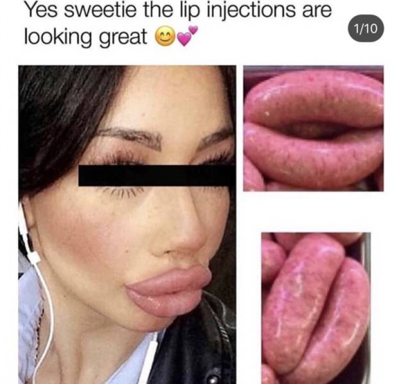 sausage lips - Yes sweetie the lip injections are looking great 110