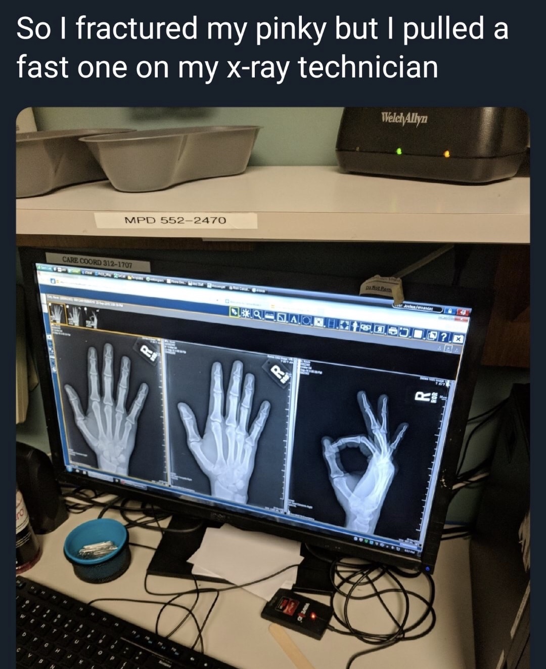 pulled a fast one on my x ray - So I fractured my pinky but I pulled a ast one on my xray technician WelchAllyn Mpd 5522470 Not Rem Care Coord 3121707 Budaice Doj.D.0?