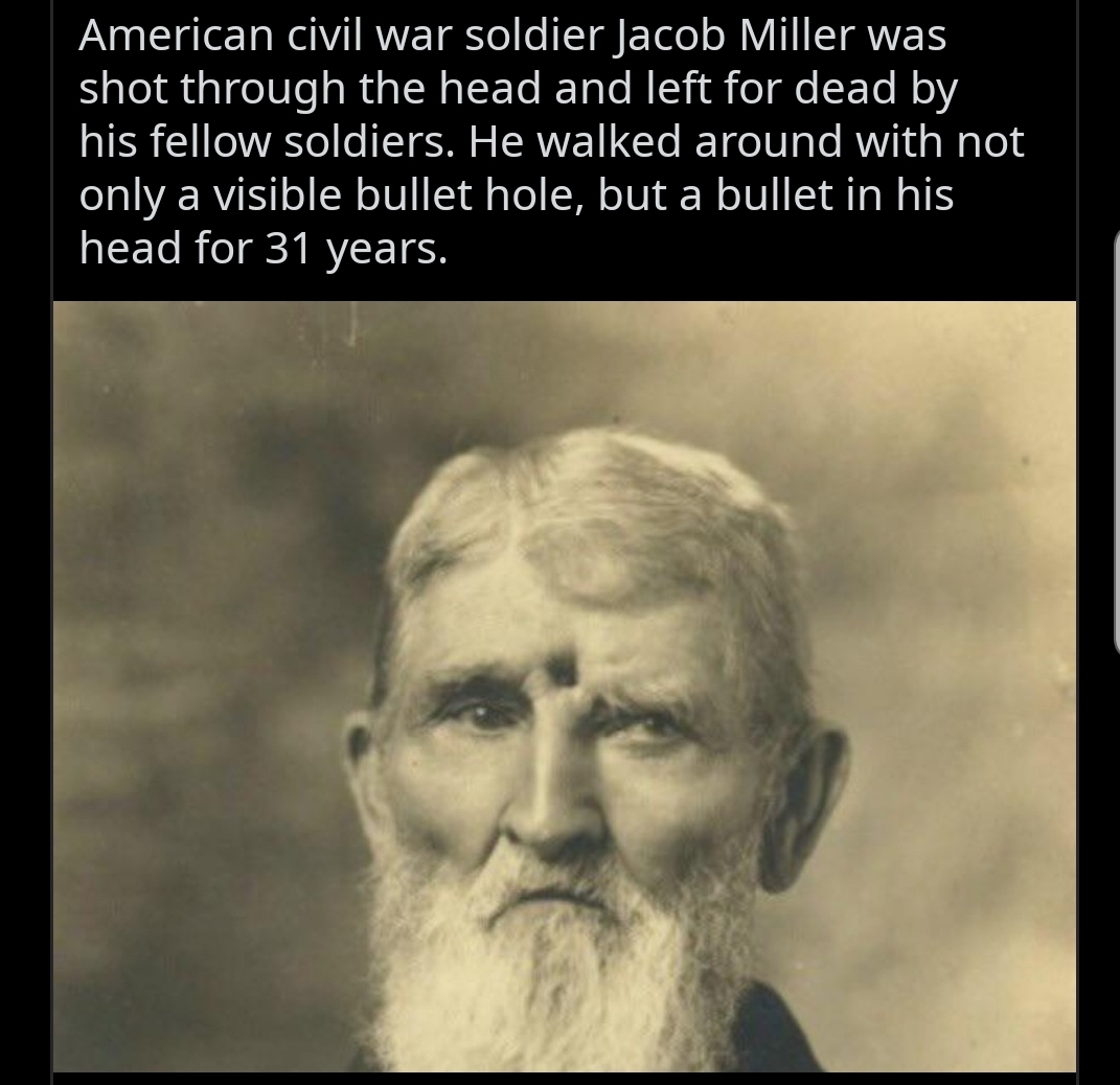 civil war soldier shot in head - American civil war soldier Jacob Miller was shot through the head and left for dead by his fellow soldiers. He walked around with not only a visible bullet hole, but a bullet in his head for 31 years.