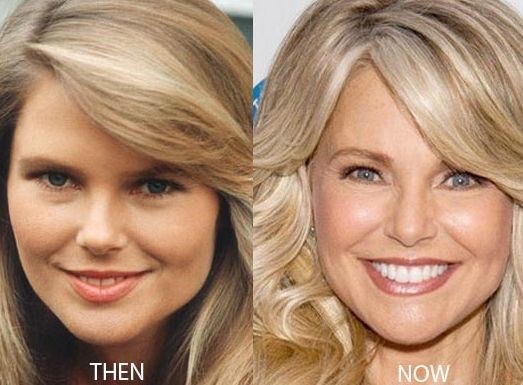 christie brinkley face before and after - Then Now