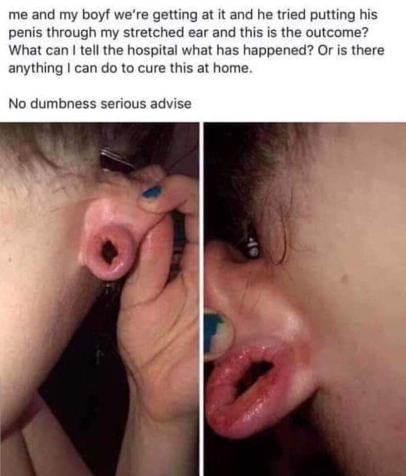 penis in ear - me and my boyf we're getting at it and he tried putting his penis through my stretched ear and this is the outcome? What can I tell the hospital what has happened? Or is there anything I can do to cure this at home. No dumbness serious advi