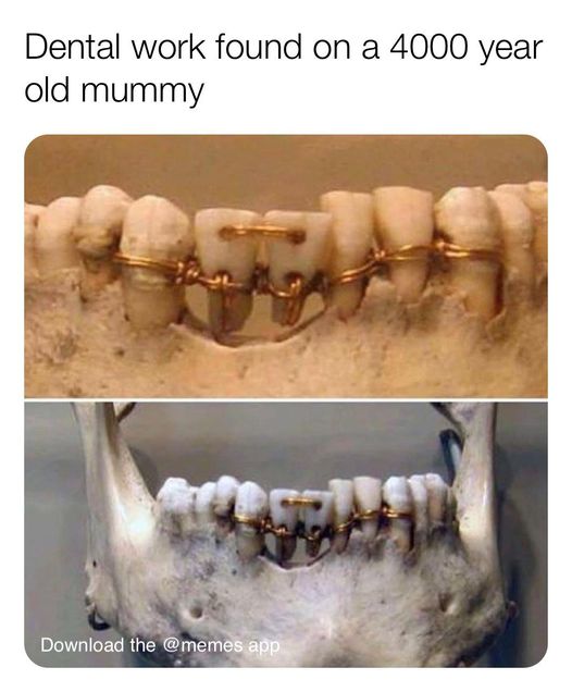 ancient egyptian dental work - Dental work found on a 4000 year old mummy Download the app