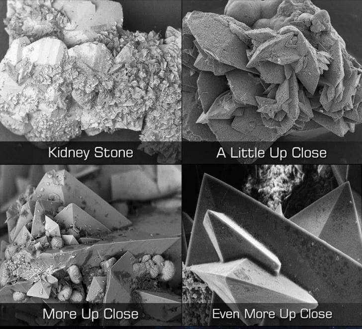funny pics and randoms  - kidney stone under microscope - Kidney Stone More Up Close A Little Up Close Even More Up Close