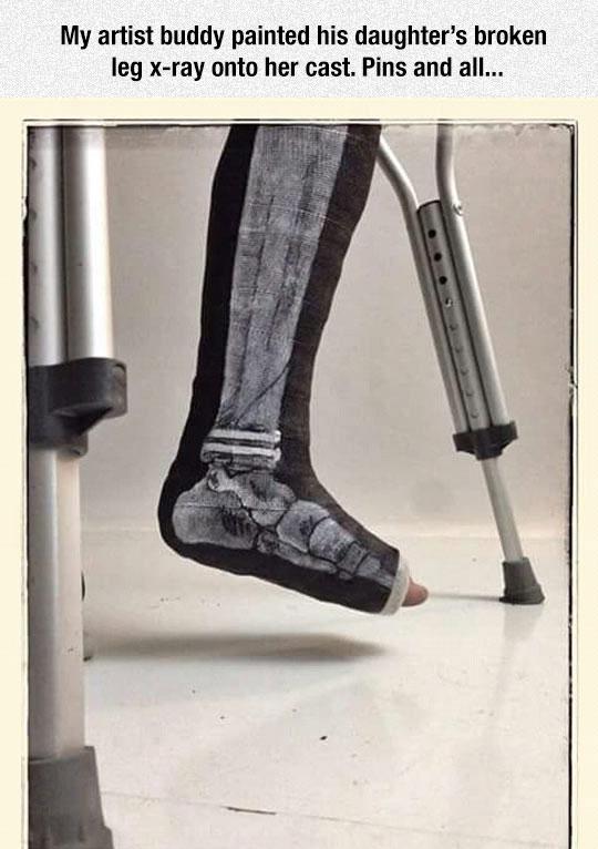 funny pics and randoms  - leg cast xray drawing - My artist buddy painted his daughter's broken leg xray onto her cast. Pins and all...