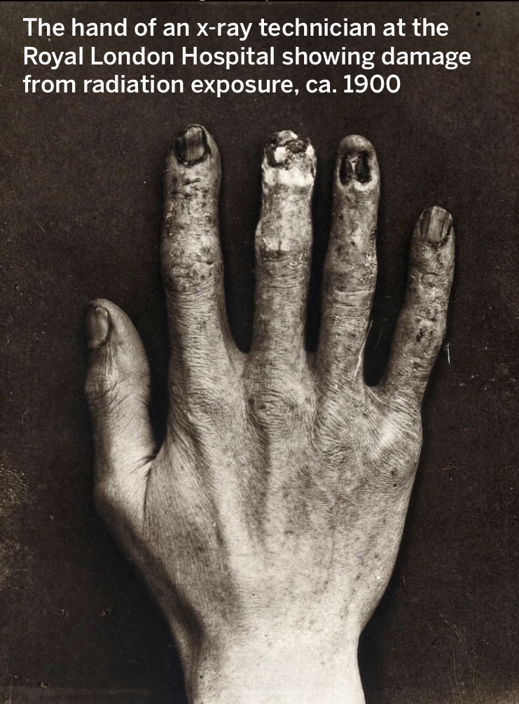 daily dose of randoms - x ray technician hand - The hand of an xray technician at the Royal London Hospital showing damage from radiation exposure, ca. 1900