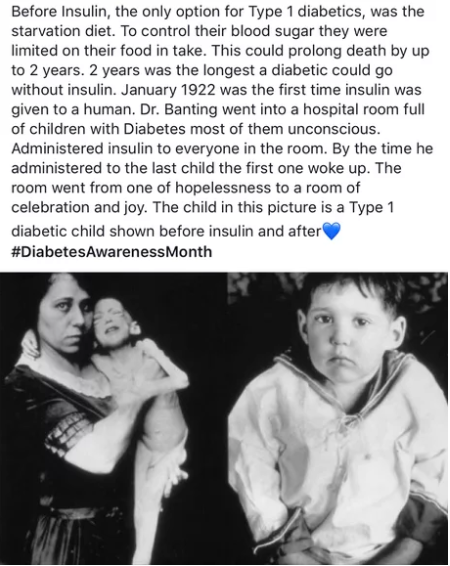 daily dose of randoms - first insulin patient - Before Insulin, the only option for Type 1 diabetics, was the starvation diet. To control their blood sugar they were limited on their food in take. This could prolong death by up to 2 years. 2 years was the