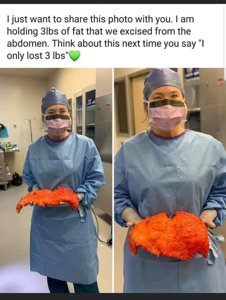 pics and memes daily dose - surgeon's assistant - I just want to this photo with you. I am holding 3lbs of fat that we excised from the abdomen. Think about this next time you say "I only lost 3 lbs" F