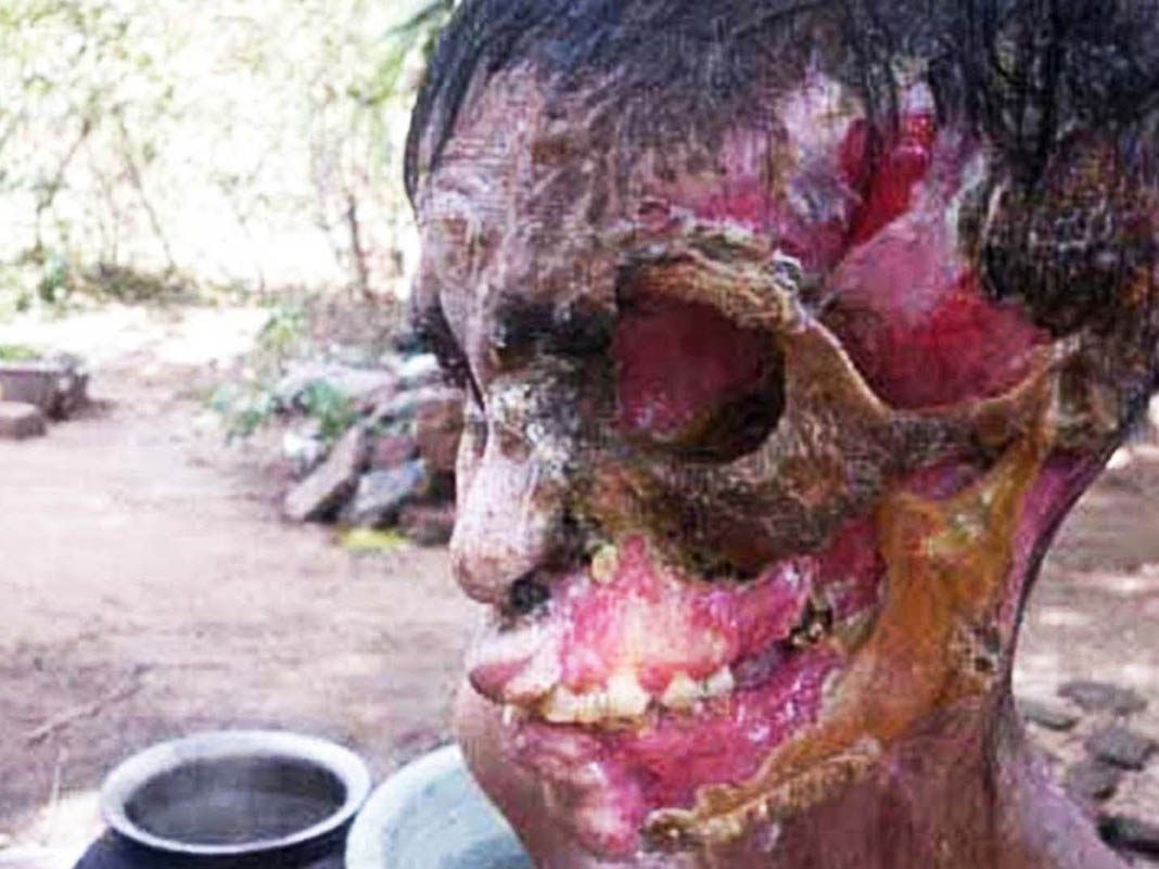 A Gallery Of Gruesome Diseases