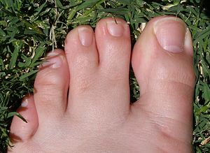 human oddity causes webbed toes