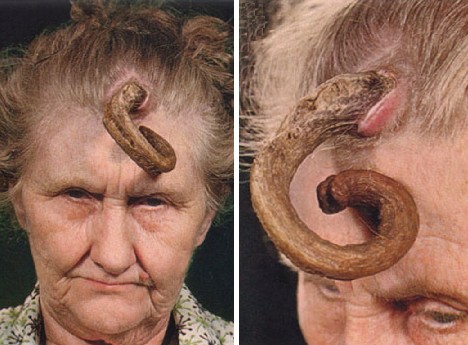 human oddity cutaneous horn