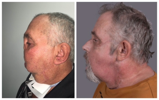 21 Before And After Facial Transplant Images