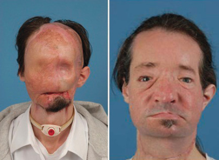21 Before And After Facial Transplant Images