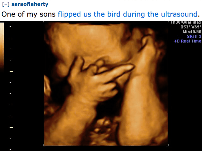 ultrasound middle finger - saraoflaherty One of my sons flipped us the bird during the ultrasound. usugua max B53V65 Mix4060 Sri Ii 3 4D Real Time